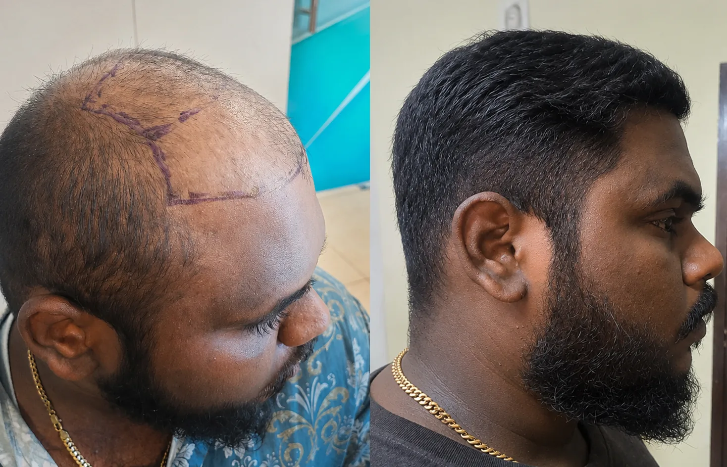 Client hair growth progress eight months after transplant at Trichogem